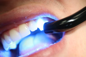 Can Fillings Look Like Your Natural Teeth? - TruCare Dentistry